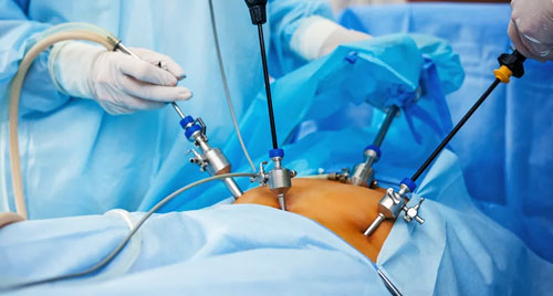 Laparoscopic Procedures