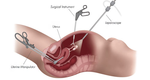 Laparoscopic Total Abdominal Hysterectomy