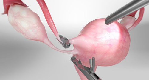 Laparoscopic Tubal Ligation