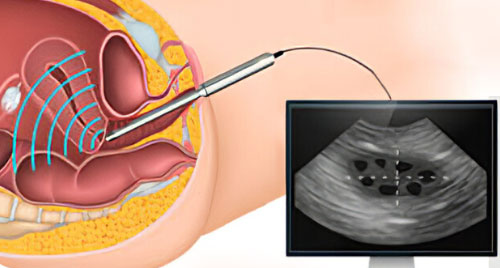 Ultrasonography TVS