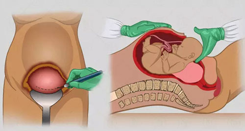 Lower Segment Caesarean Section